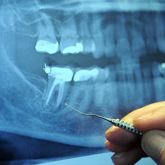 Is There A Relationship Between Root Canals And Cancer?