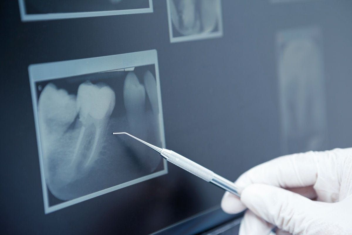 Photo of a dentist holding a tool in front of an x-ray of a tooth