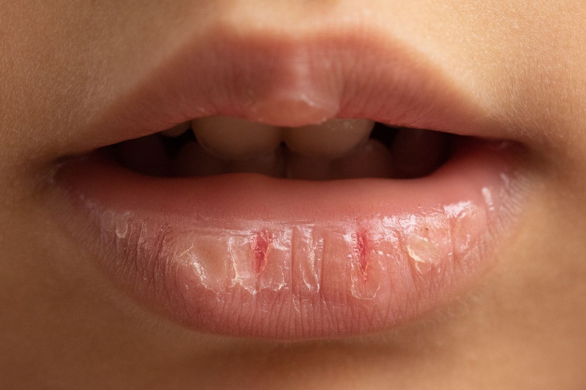 A close up of a person with dry and cracked lips