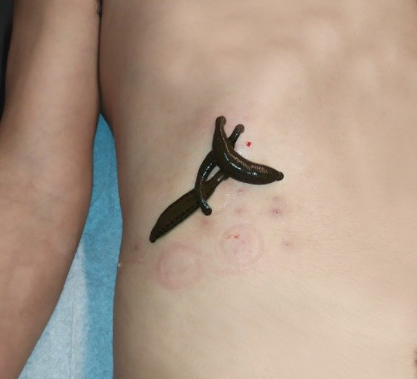 עלוקות רפואיות