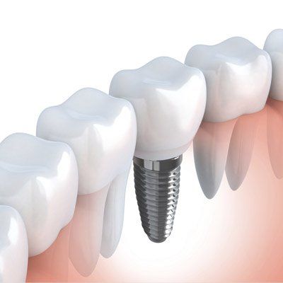Dental Implant —  Implants in Silver Spring, MD