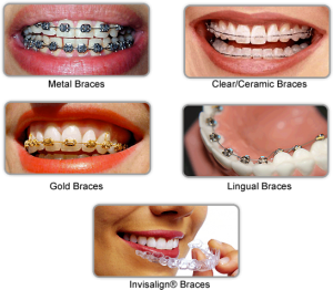 San Jose Orthodontist, Braces, 408-259-2900