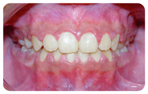 Teeth Frontal View