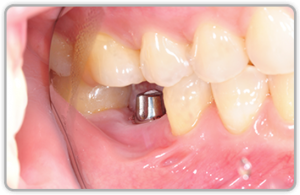 Gum With Dental Implant