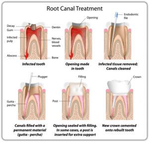 Root Canal Treatment Chart