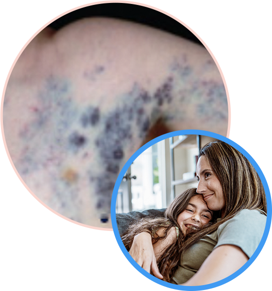 VM Disease on the surface of the skin