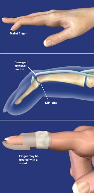 DIP Joint Osteoarthritis: How to Treat this Common Form of Arthritis