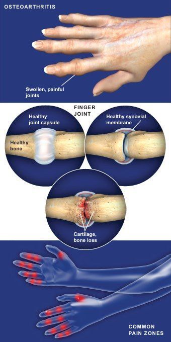 How to drain a finger paronychia | Medmastery