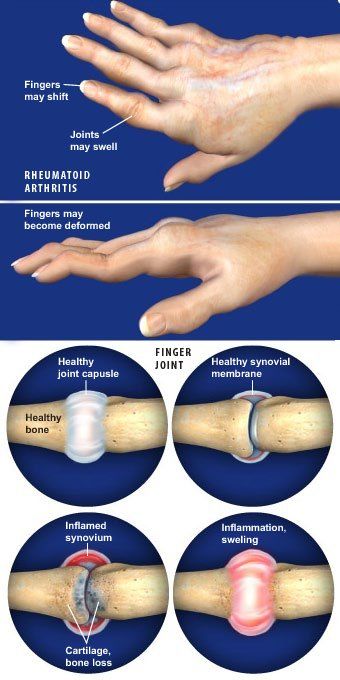 Causes of Swollen Finger Joints and How to Treat Them