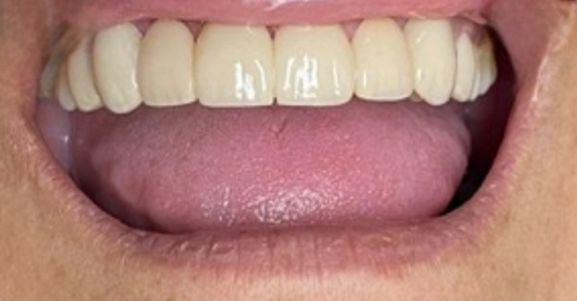 A close up of a woman 's mouth with white teeth.