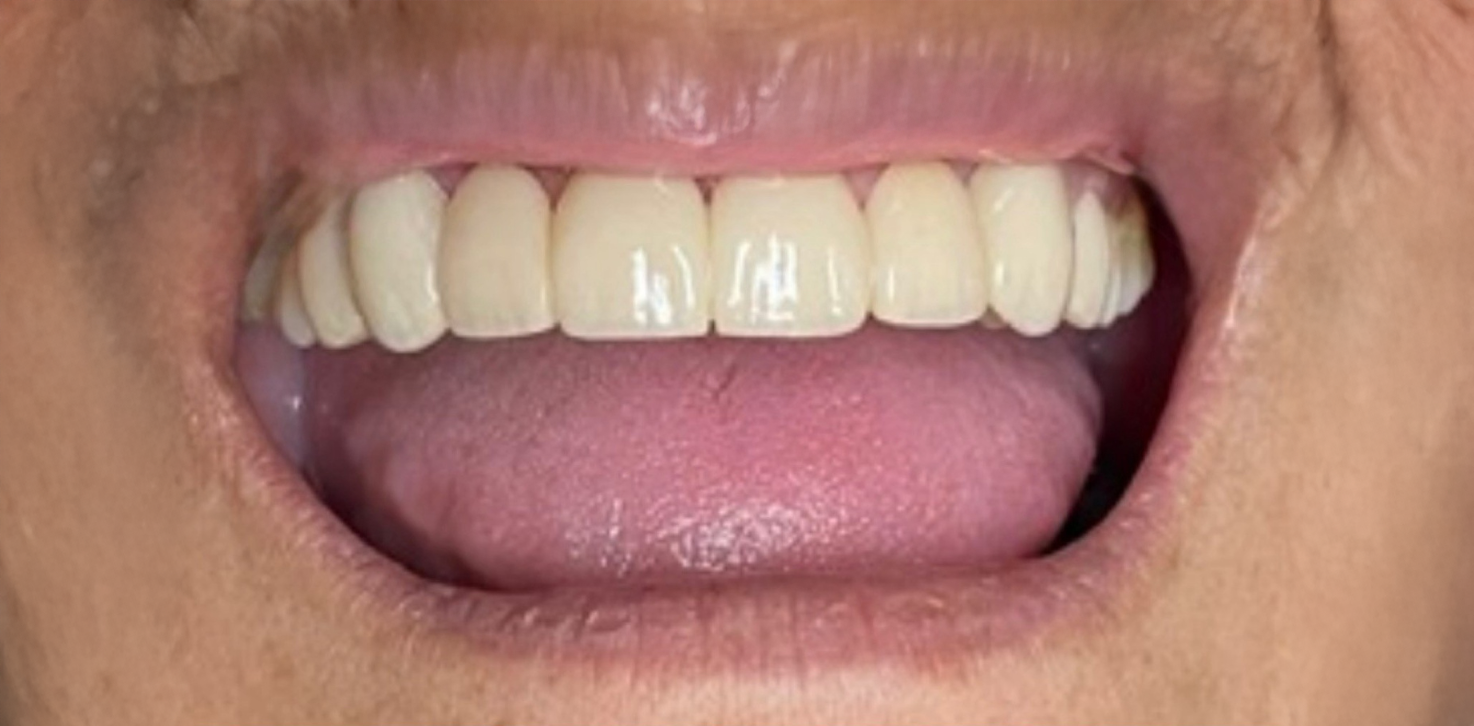 A close up of a woman 's mouth with white teeth.