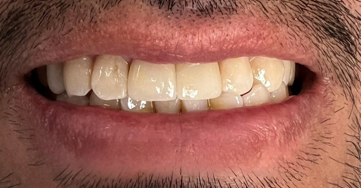 A close up of a man 's mouth with a beard and teeth.