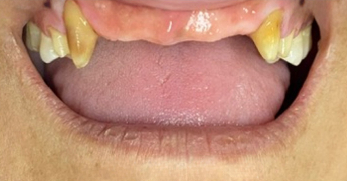 A close up of a woman 's mouth with a broken tooth.