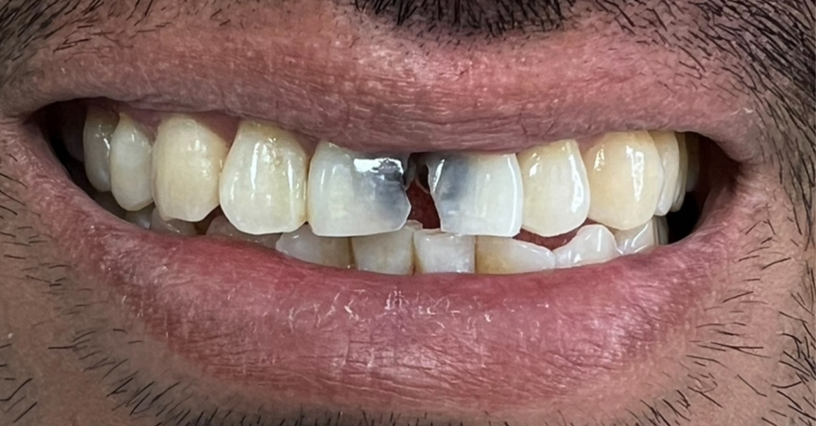 A close up of a man 's mouth with a beard and missing teeth.