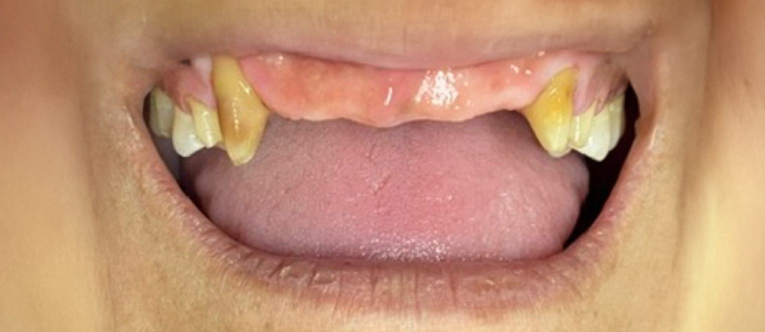 A close up of a woman 's mouth with a broken tooth.