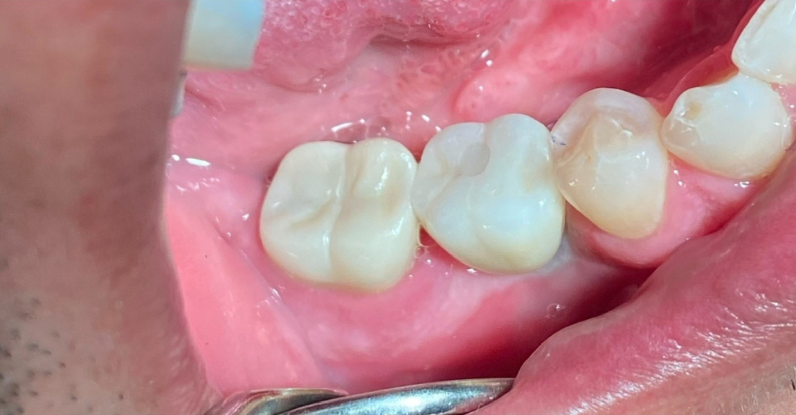 A close up of a person 's teeth and gums.