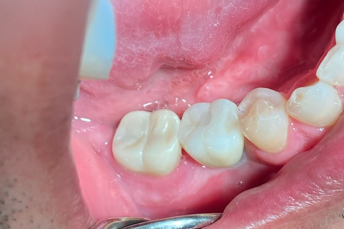A close up of a person 's teeth and gums.