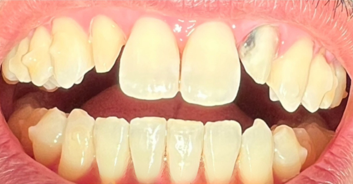 A close up of a person 's teeth with a missing tooth.