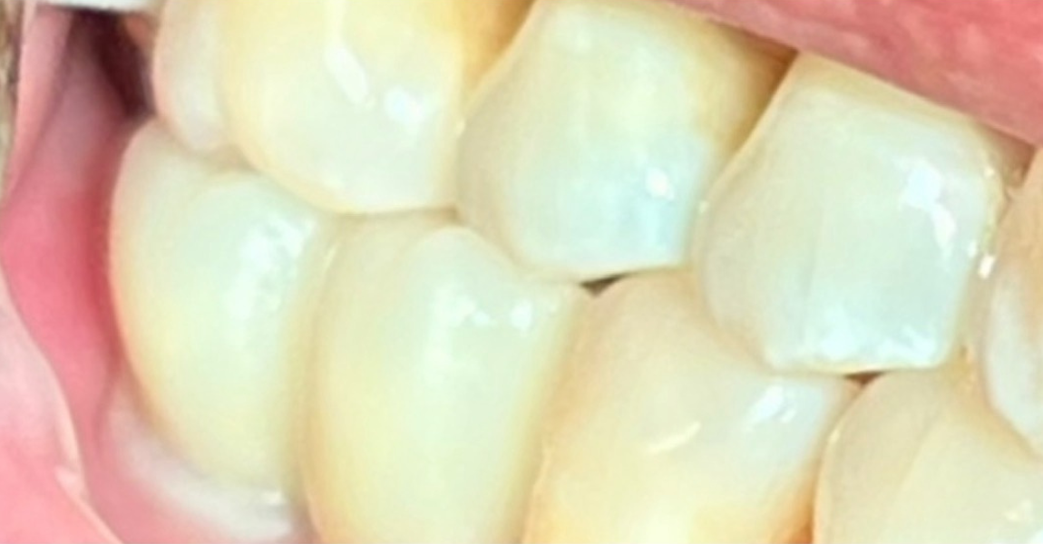 A close up of a person 's smile with white teeth