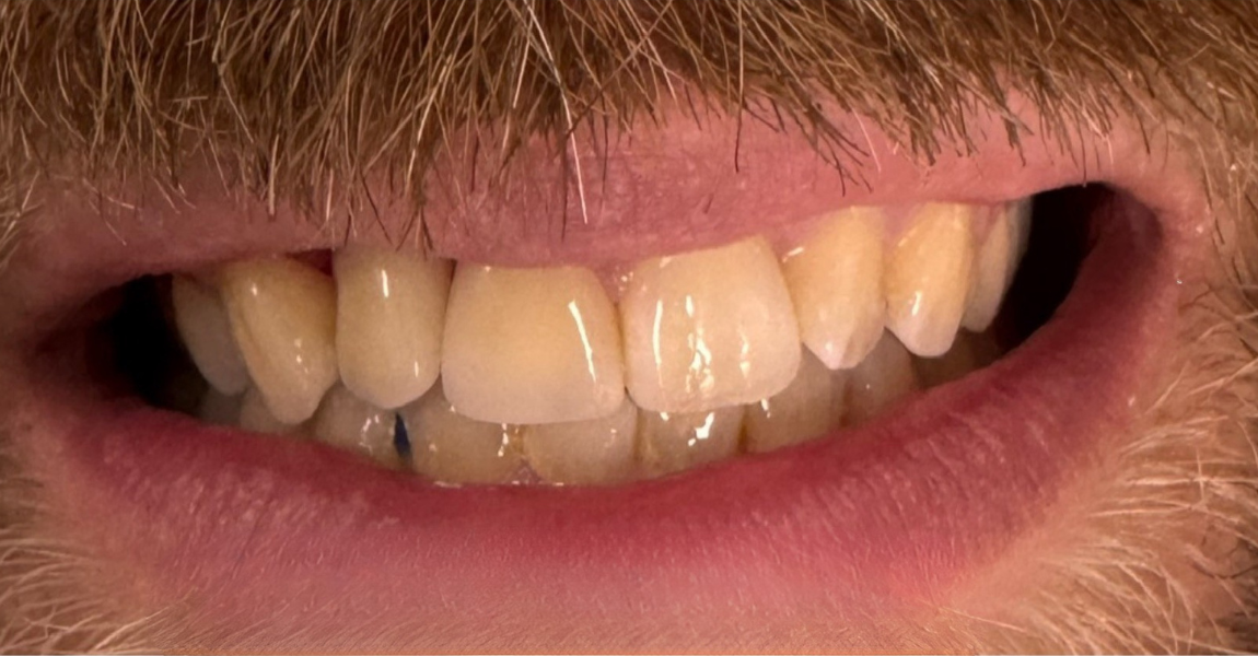 A close up of a man 's face with a mustache and teeth.