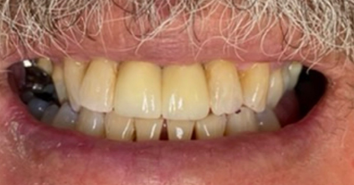 A close up of a woman 's mouth with white teeth.