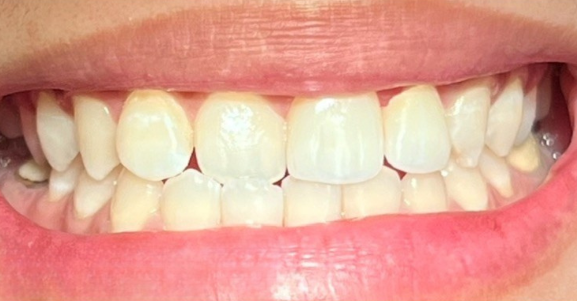 A close up of a man 's teeth with two tooth shades in his mouth.