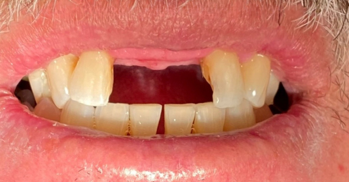 A close up of a woman 's mouth with a broken tooth.