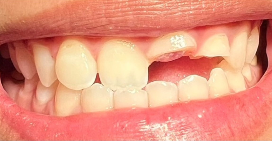 A close up of a man 's teeth with a tooth color chart in his mouth.