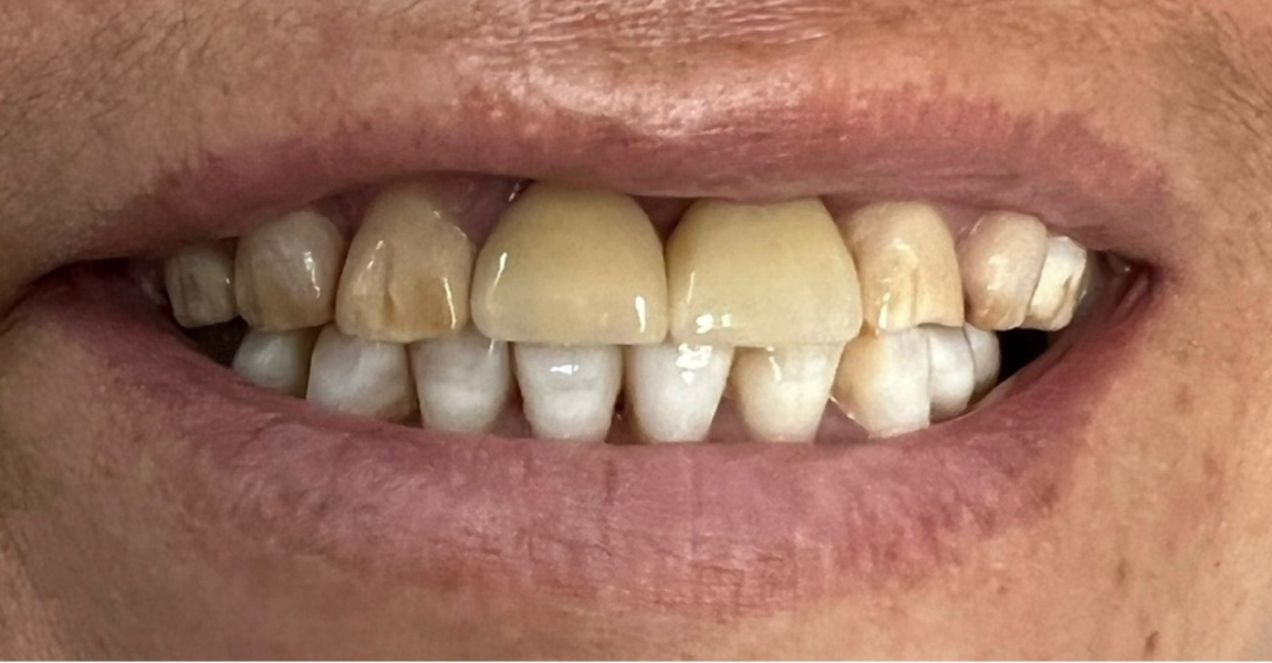 A close up of a person 's teeth and gums.