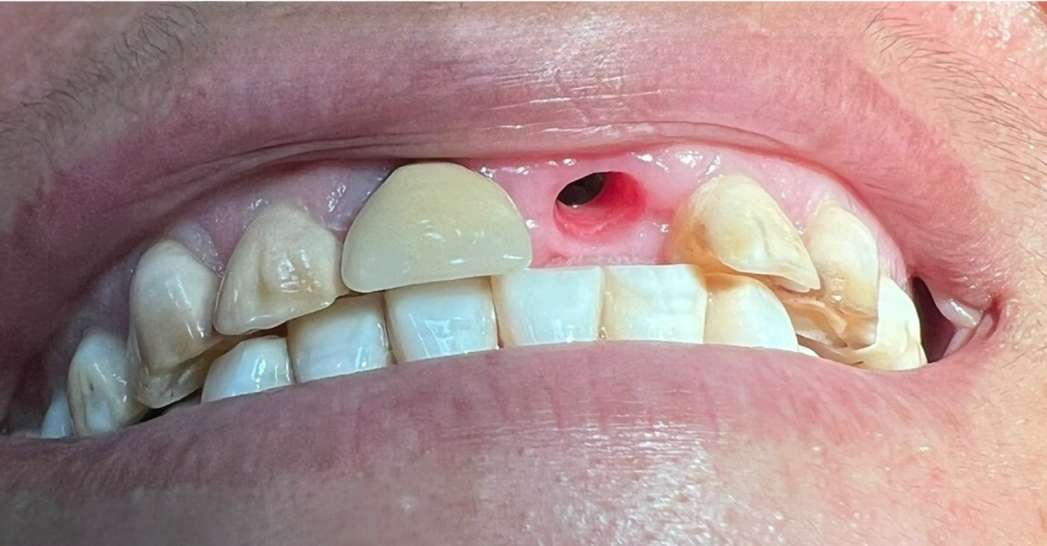 A close up of a person 's teeth and mouth.
