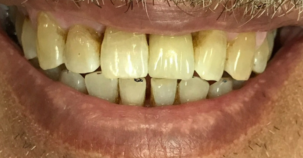 A close up of a person 's smile with white teeth