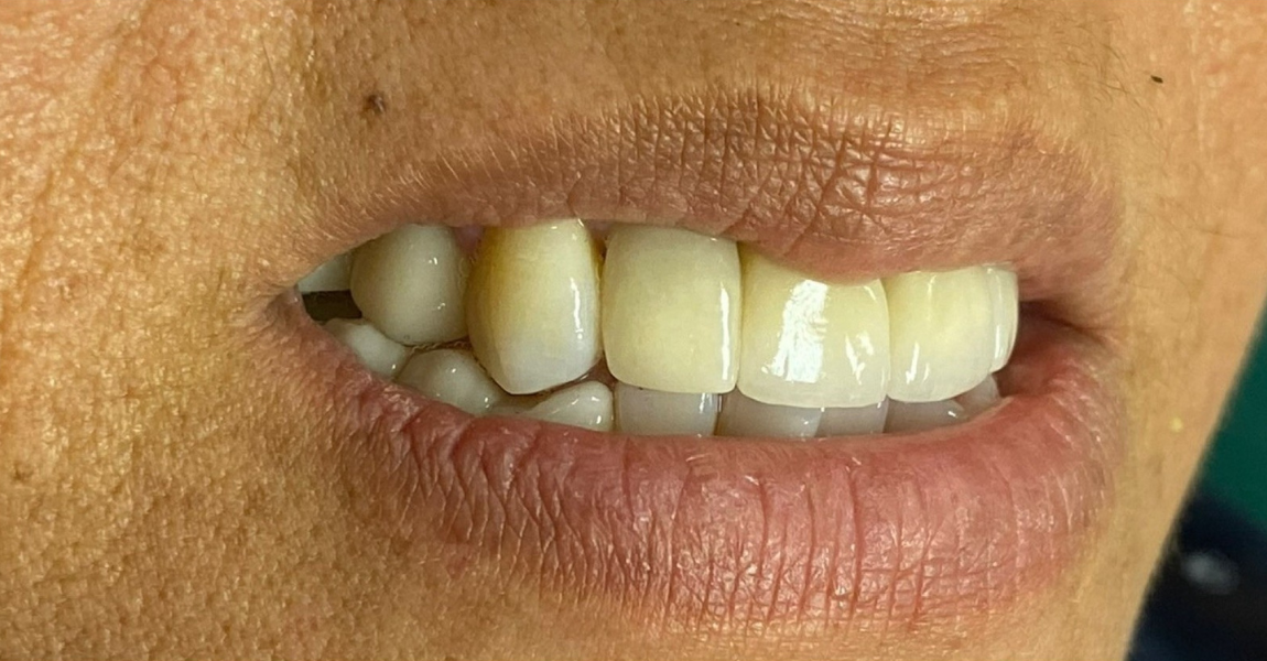 A close up of a woman 's mouth with white teeth.