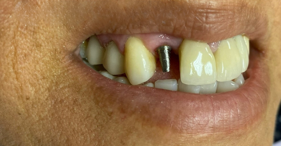 A close up of a woman 's mouth with a broken tooth.