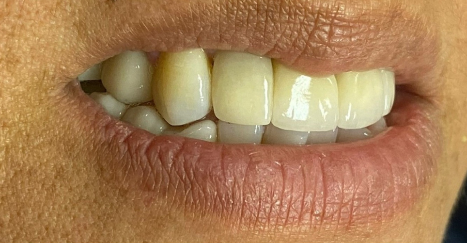 A close up of a woman 's mouth with white teeth.