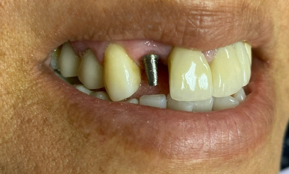 A close up of a woman 's mouth with a broken tooth.