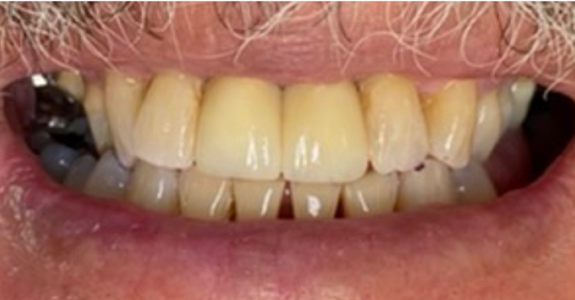 A close up of a person 's teeth and gums.