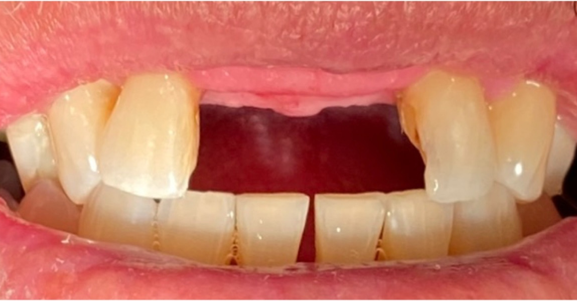 A close up of a person 's teeth and mouth.