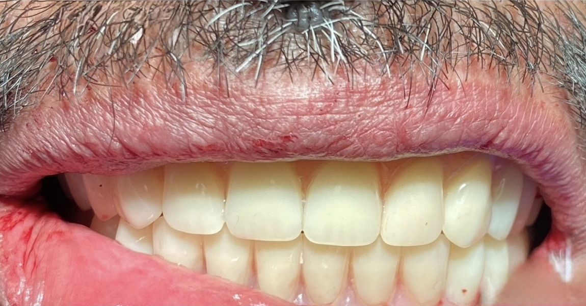A close up of a woman 's smile with white teeth.