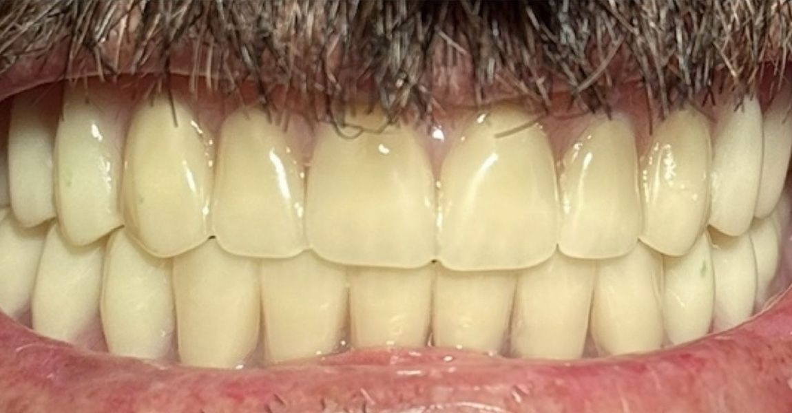 A close up of a man 's teeth with two tooth shades in his mouth.