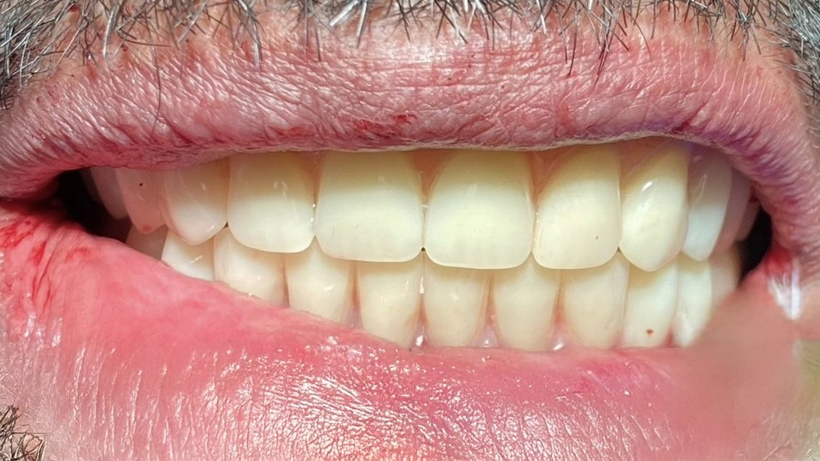 A close up of a woman 's smile with white teeth.