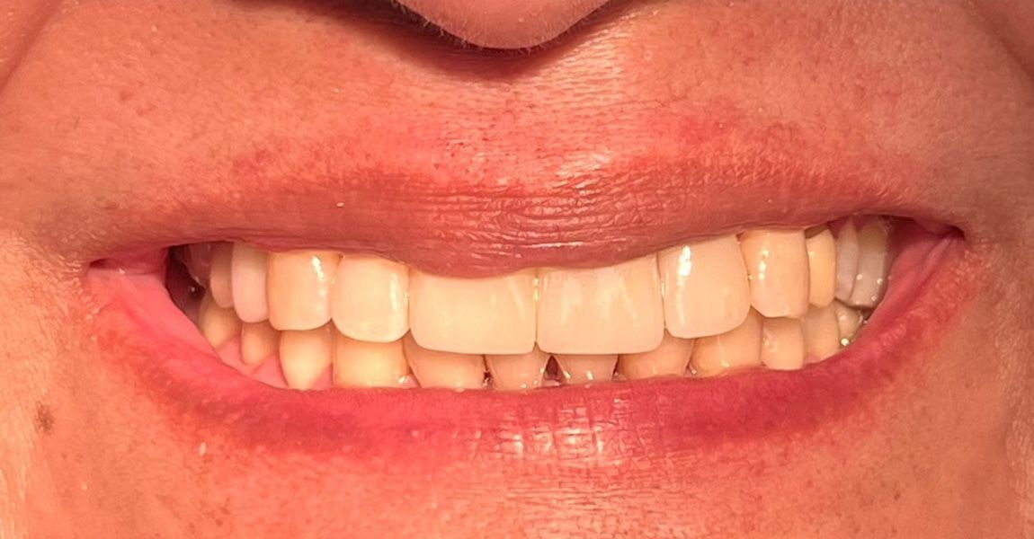 A close up of a woman 's smile with white teeth.