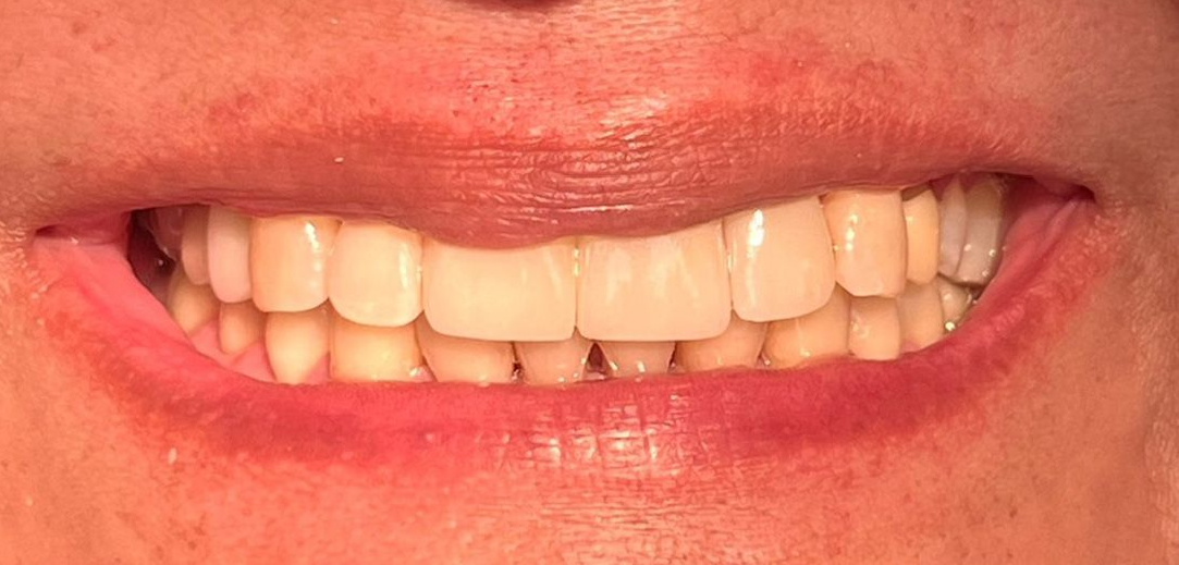 A close up of a woman 's smile with white teeth.