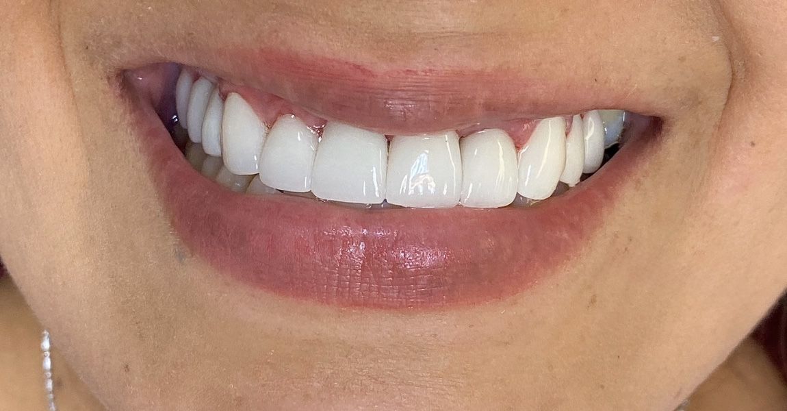 A close up of a woman 's mouth with white teeth.