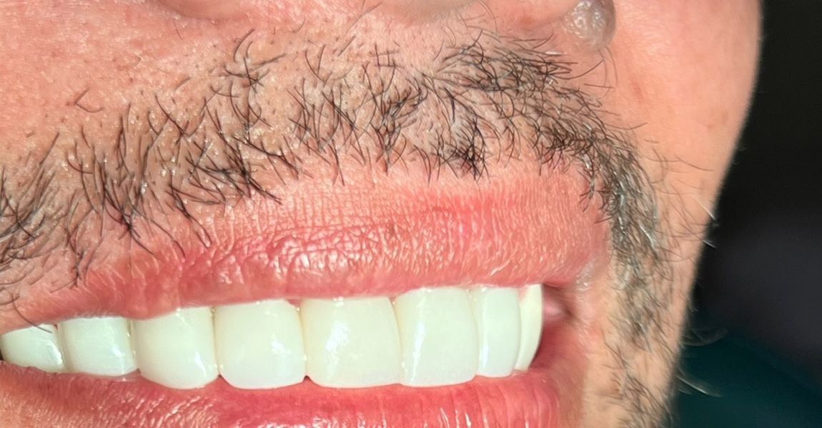 A close up of a person 's teeth with a white tooth in the middle.