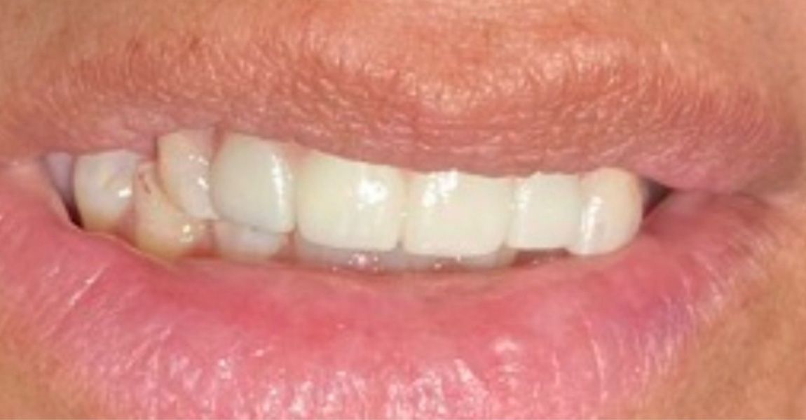 A close up of a woman 's smile with missing teeth.