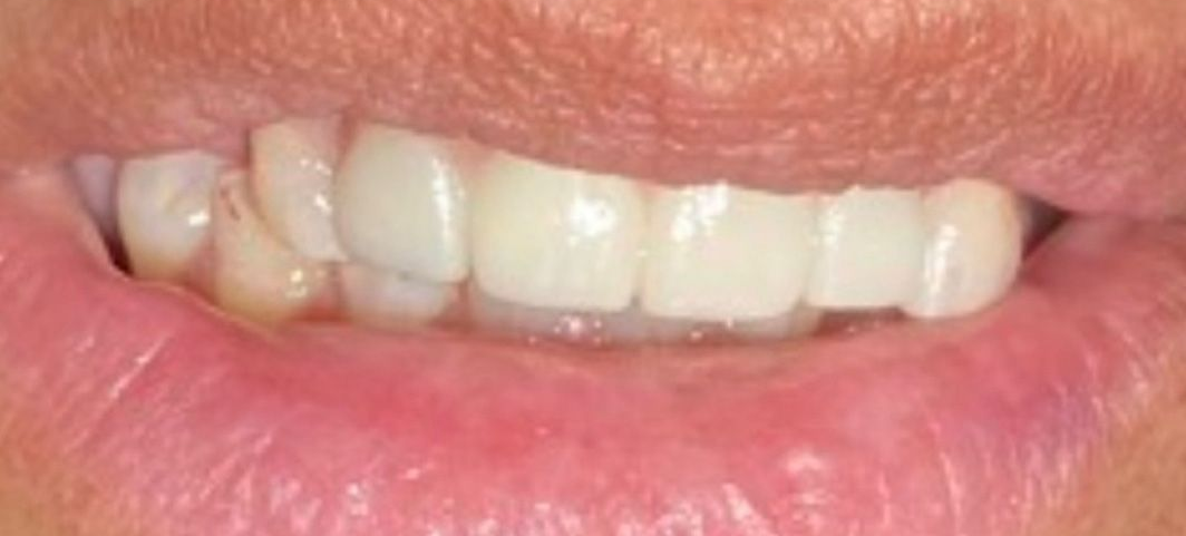 A close up of a woman 's smile with missing teeth.