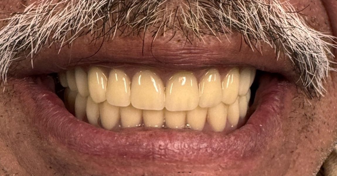 A close up of a person 's teeth with pw2 written on it
