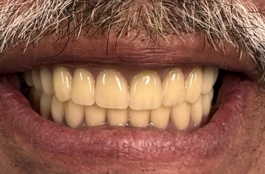 A close up of a person 's teeth with pw2 written on it