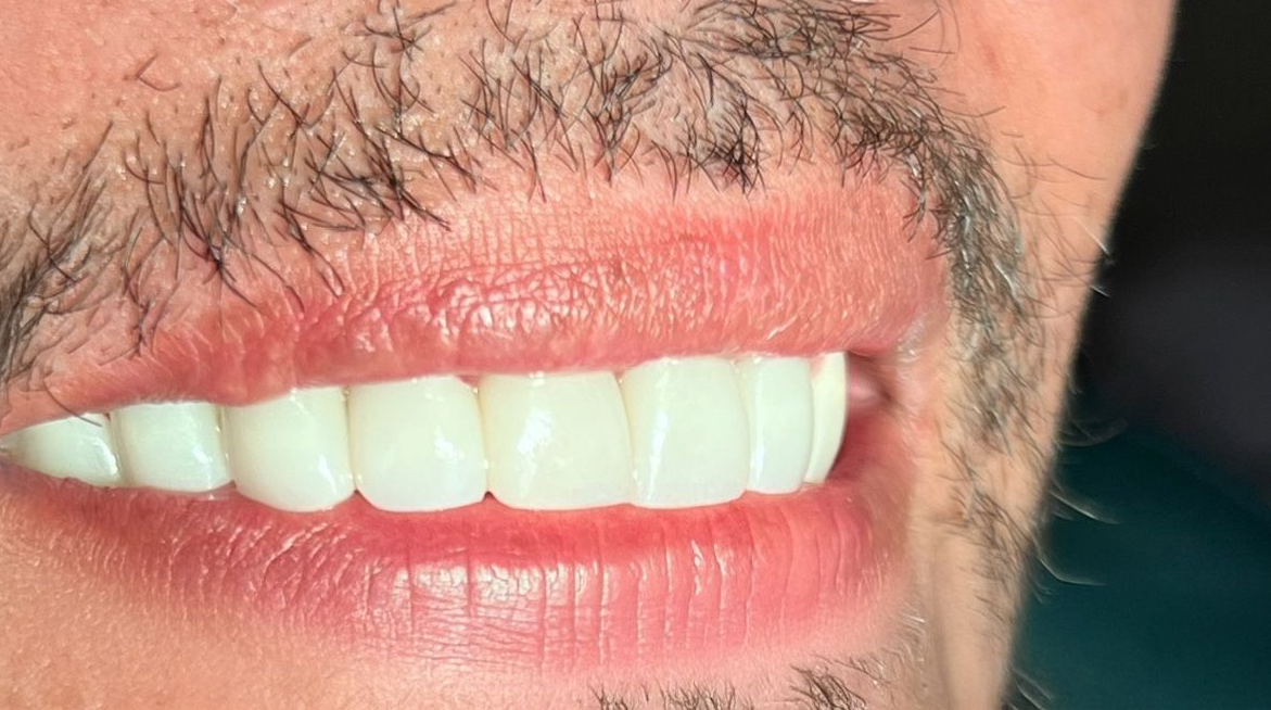 A close up of a person 's teeth with a white tooth in the middle.
