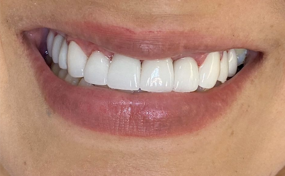 A close up of a woman 's mouth with white teeth.